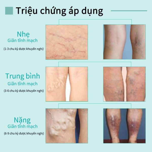 Kem Giảm Suy Giãn Tĩnh Mạch VOVA Giảm Suy Giãn tĩnh mạch, tĩnh mạch nhện, viêm, khô, tuần hoàn kém 30ml