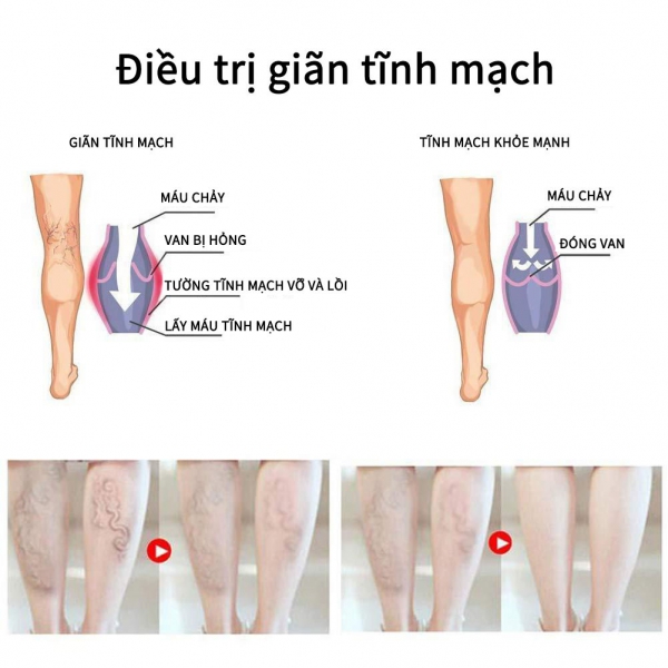 Kem Giảm Suy Giãn Tĩnh Mạch VOVA Giảm Suy Giãn tĩnh mạch, tĩnh mạch nhện, viêm, khô, tuần hoàn kém 30ml