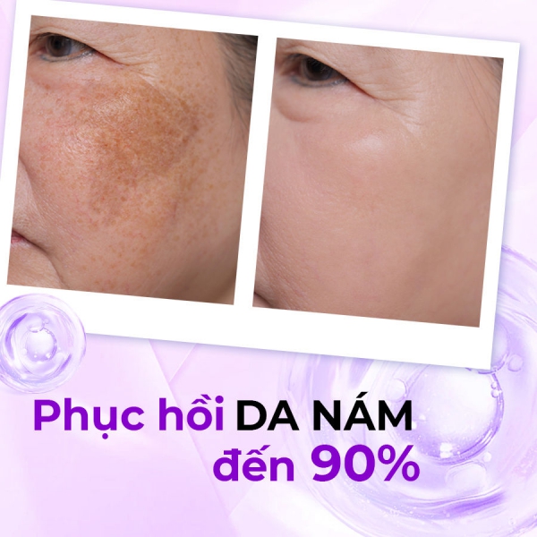 Kem Nám - Tàn Nhang - Đồi Mồi - Chống Lão Hoá, Trắng Da akala 30 gram (Tế Bào Mầm Tái Sinh & Collagen Peptide)